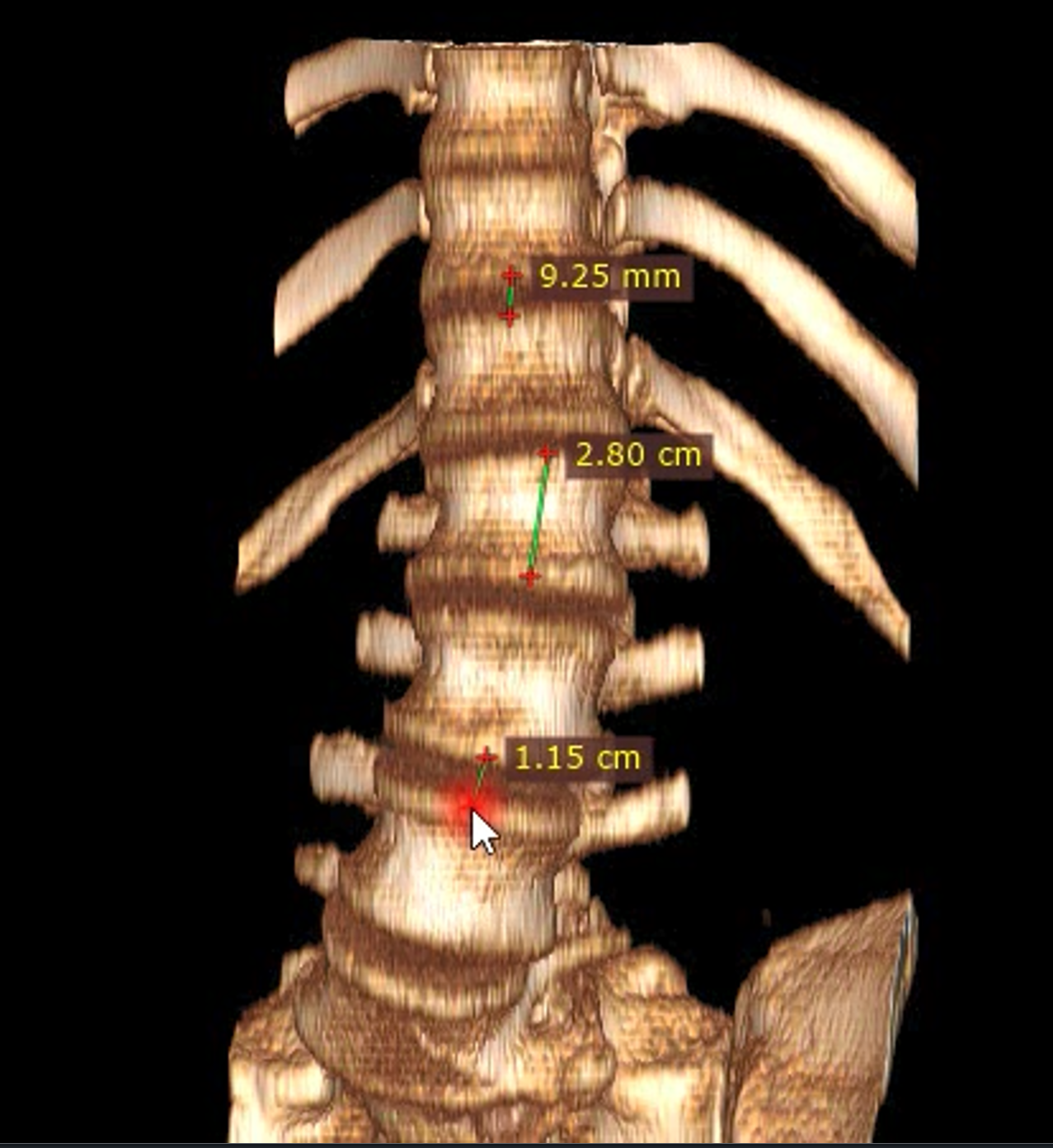 software screenshot — spinal navigation view