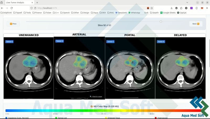 AI analysis of hepatic tumors from four dynamic imaging phases